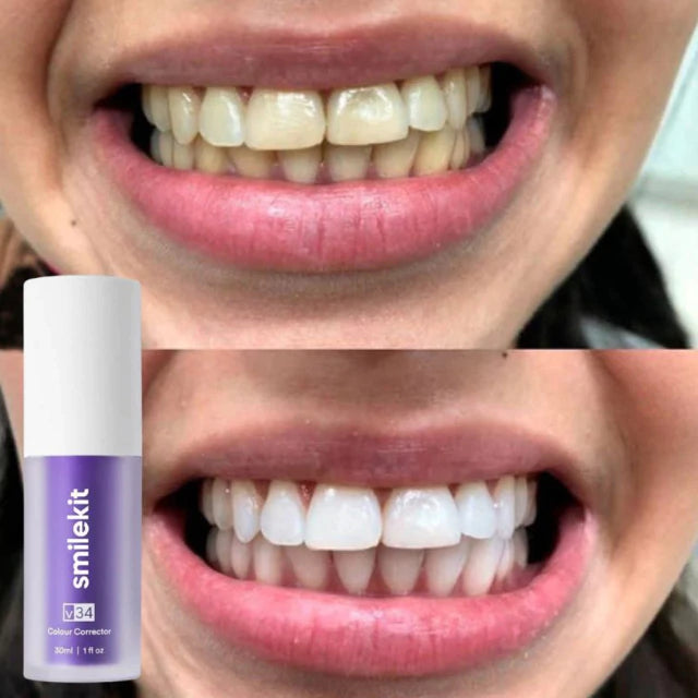 SmileKit V34 - Tus dientes más blancos